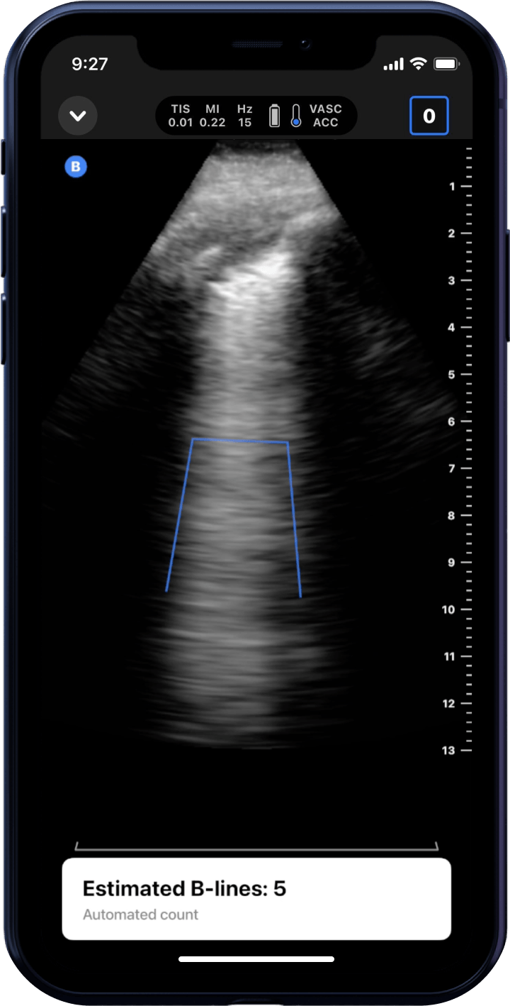 Butterfly iQ3™ Portable Ultrasound Device – 1 or 2 Probes