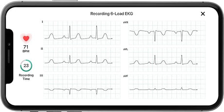 AliveCor KardiaMobile 6 Lead EKG
