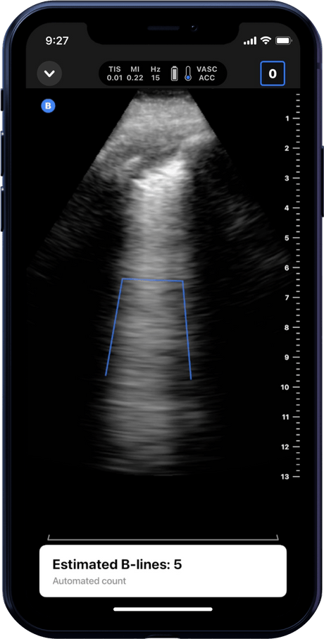 Butterfly iQ3™ Portable Ultrasound Device – 1 or 2 Probes