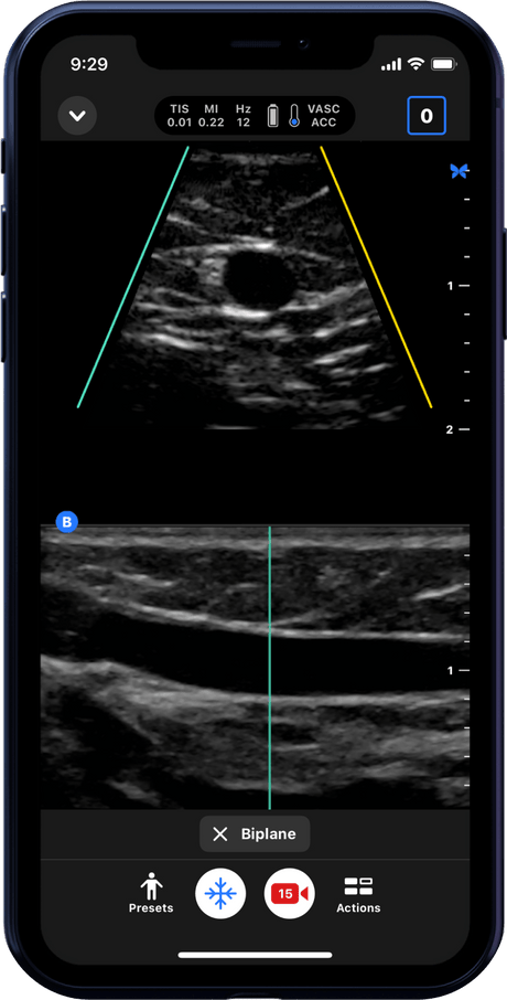 Butterfly iQ3™ Portable Ultrasound Device – 1 or 2 Probes