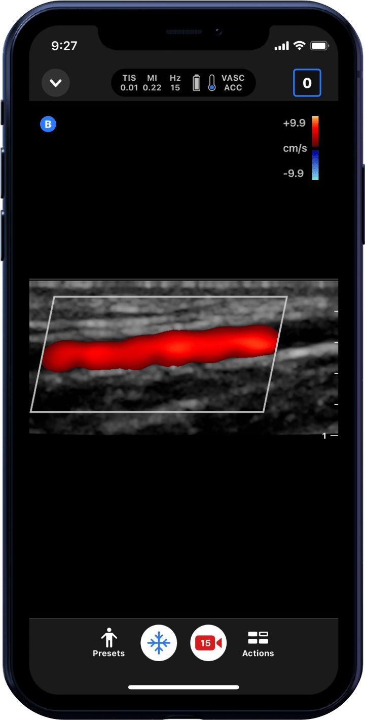 Butterfly iQ3™ Portable Ultrasound Device – 1 or 2 Probes