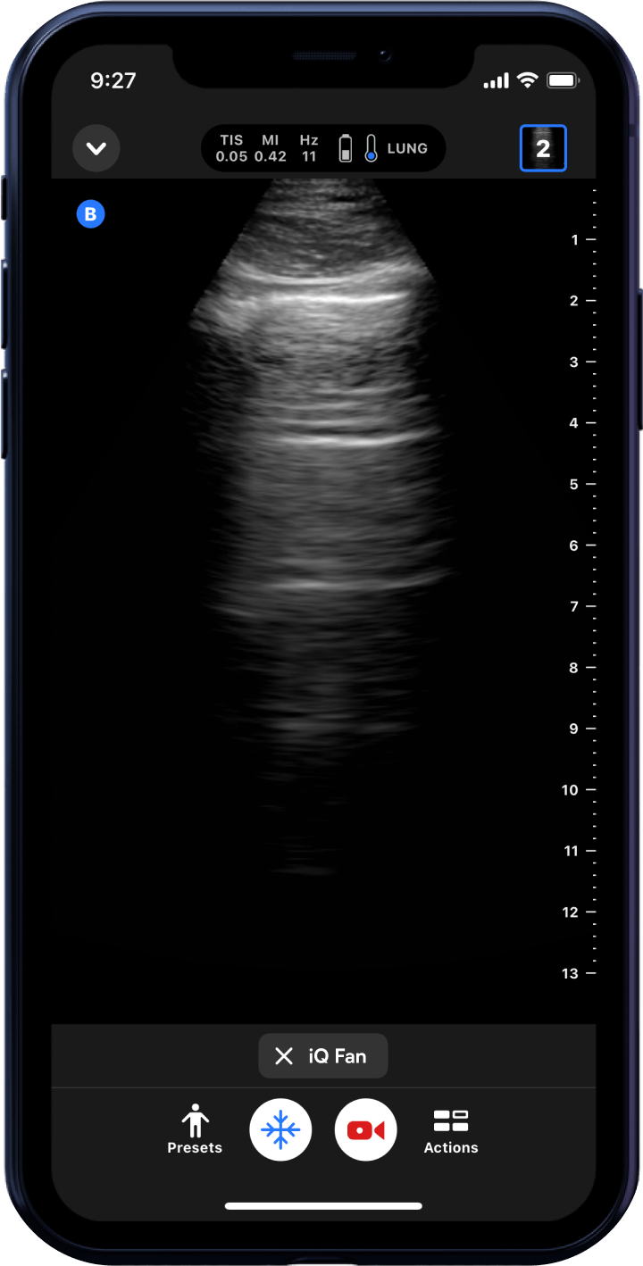 Butterfly iQ3™ Portable Ultrasound Device – 1 or 2 Probes