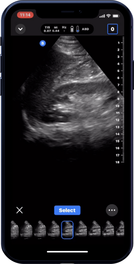 Butterfly iQ3™ Portable Ultrasound Device – 1 or 2 Probes