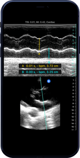 Butterfly iQ3™ Portable Ultrasound Device – 1 or 2 Probes