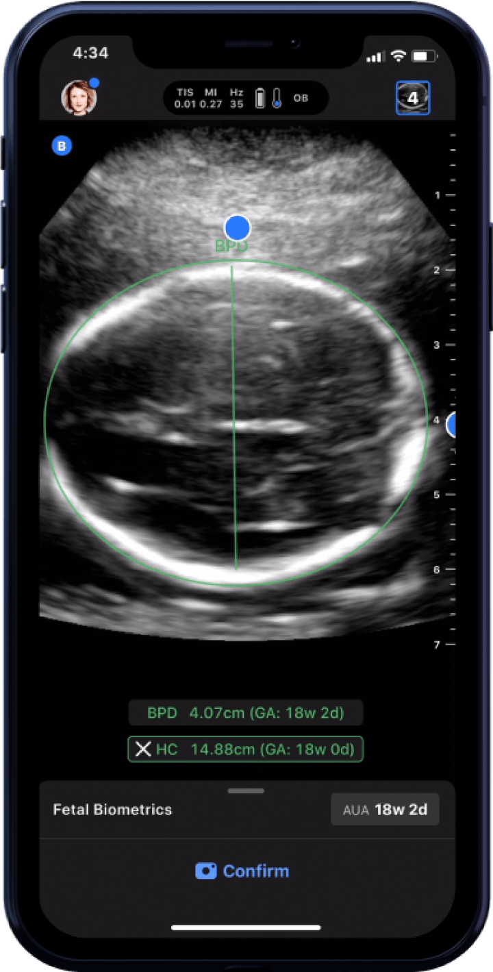 Butterfly iQ3™ Portable Ultrasound Device – 1 or 2 Probes