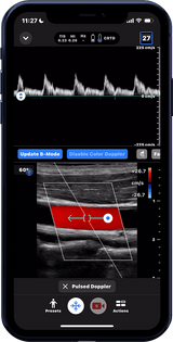 Butterfly iQ3™ Portable Ultrasound Device – 1 or 2 Probes